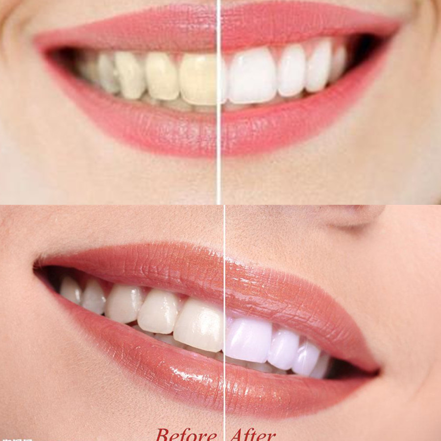Bambus Holzkohle Zähne Zahn De – Teeth Whitening Near Me Bewertung und Preis