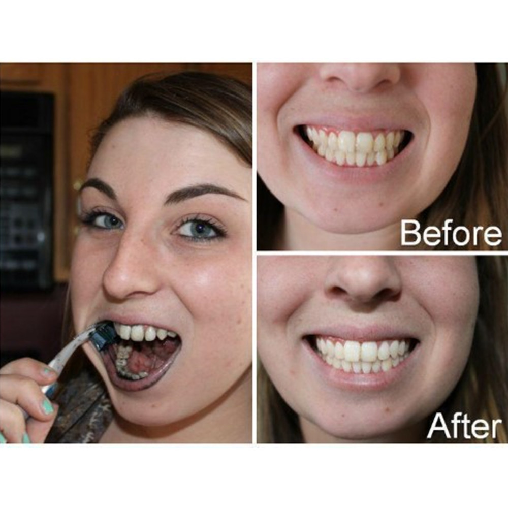 Bambus Holzkohle Zähne Zahn De – Teeth Whitening Near Me Bewertung und Preis