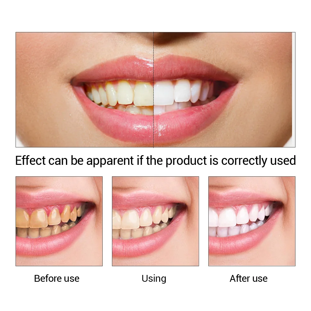 FTEENPLY Zahnaufhellung Essenz – Teeth Whitening Near Me Bewertung und Preis