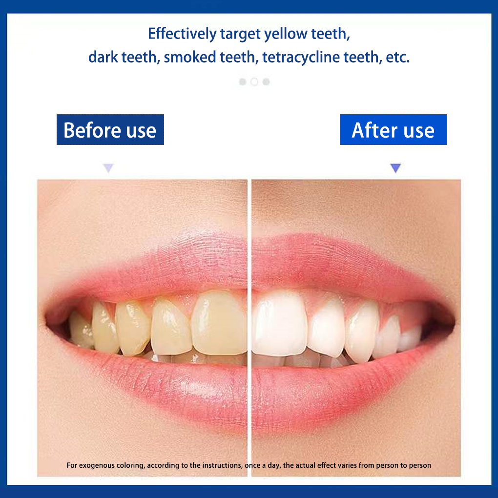 70/140 Paar 5D weiße Zahnaufhe – Teeth Whitening Effects Bewertung und Preis