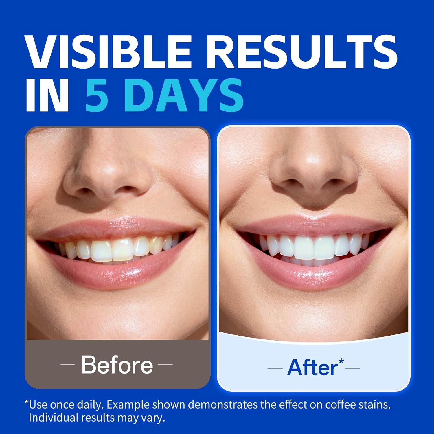 KHAZIX Zahnaufhellungsstreifen – Teeth Whitening Oil Pulling Bewertung und Preis